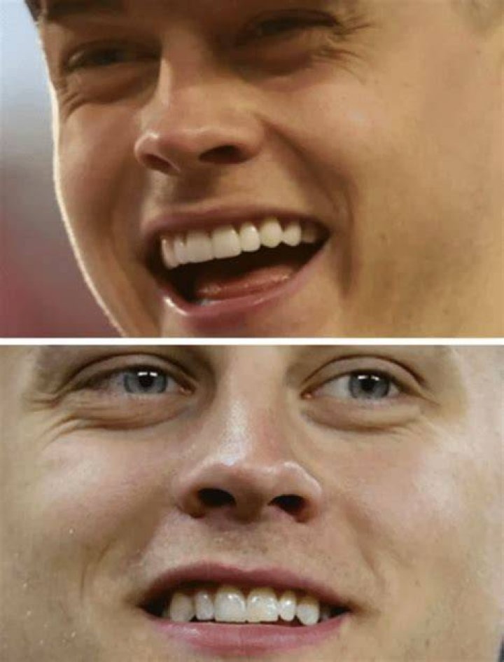 Joe Burrow Veneers vorher und nachher Neue Z&auml;hne bekommen, Joe Burrow