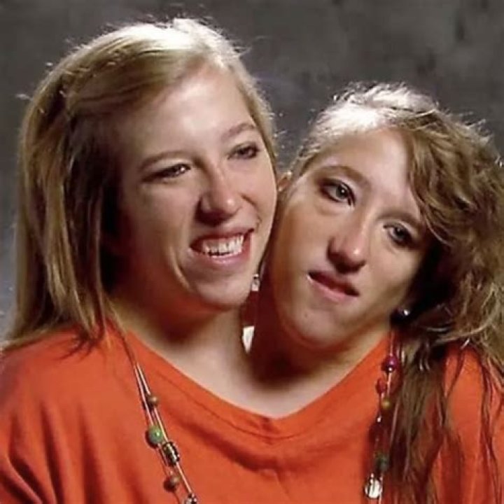 What Famous Conjoined Twins Abby And Brittany Hensel are Doing Today