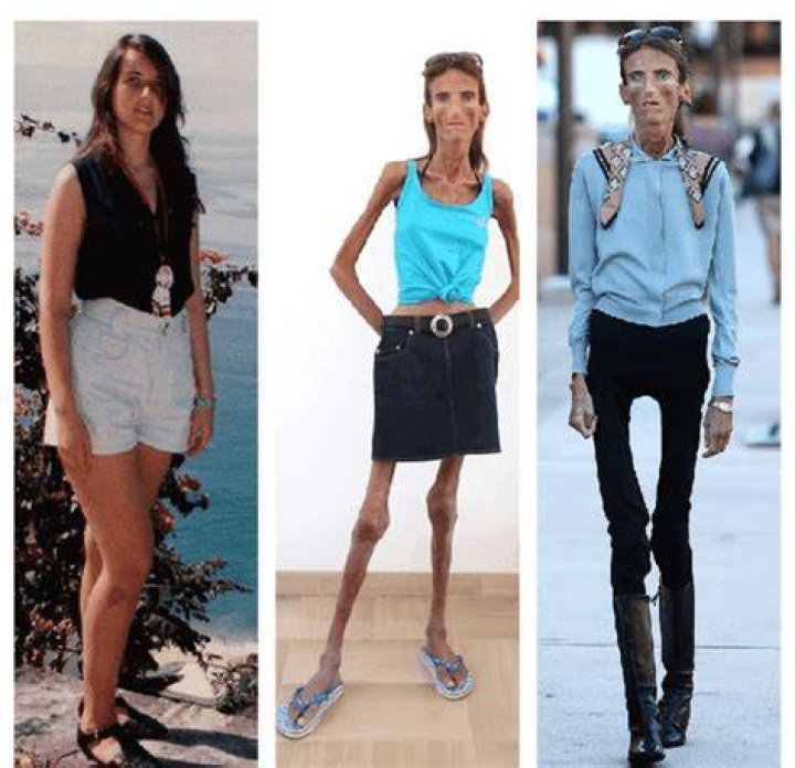 Who is the Skinniest Person in the World? It's a real shock